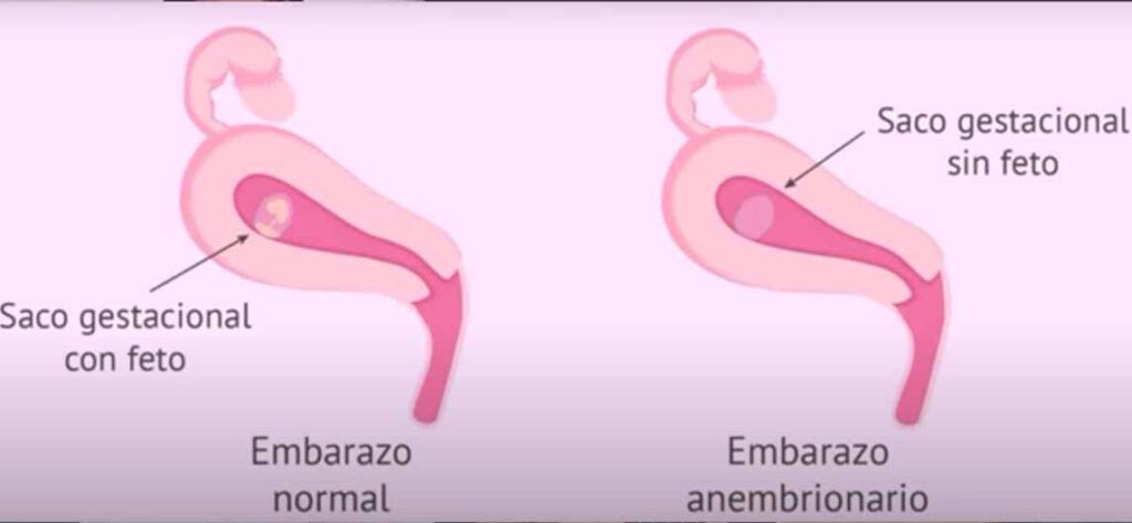 sintomas de embarazo anembrionario